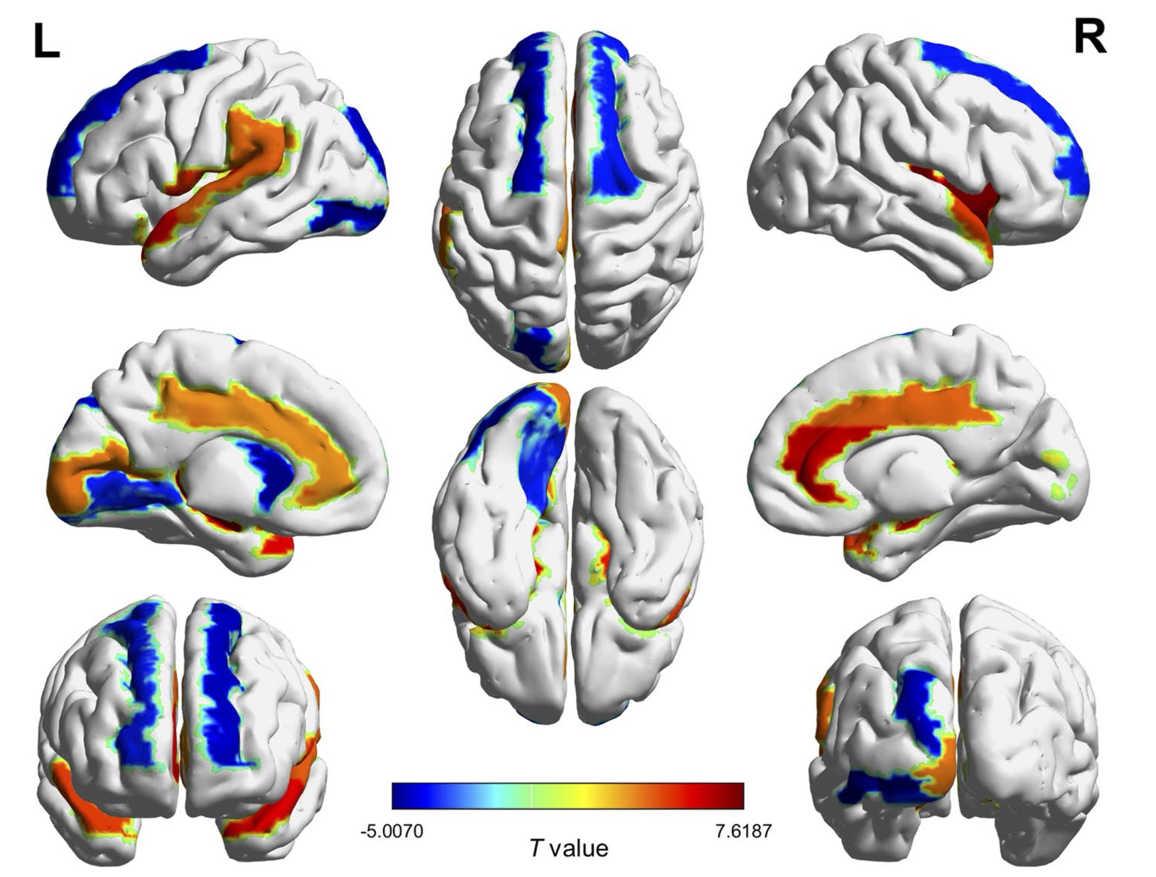 紅樓夢偽作鑑定數學模型 助揭阿茲海默症大腦結構異常